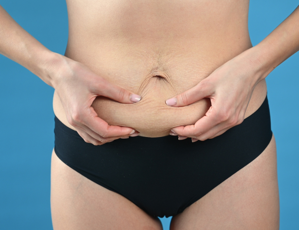 Postpartum Belly Bulge? It Might Be Diastasis Recti (and Here’s What to Do)