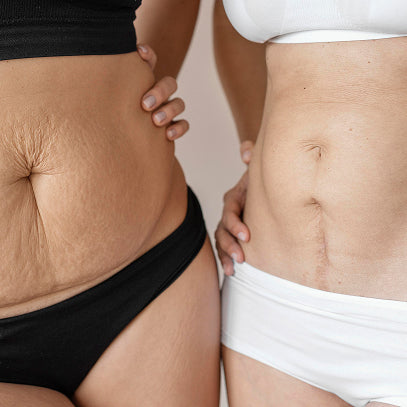 Diastasis Recti Recovery