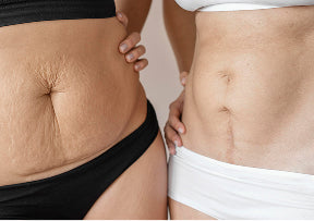 Diastasis Recti Recovery & Pelvic Recovery 